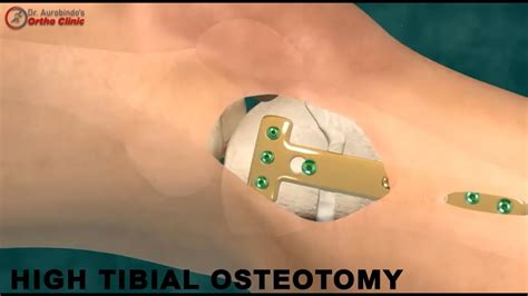 High Tibial Osteotomy Hto Knee Surgery Dr Aurobindo Das Best