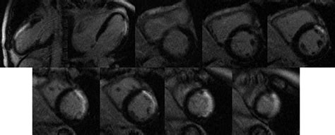 Late Gadolinium Enhanced Cardiovascular Mri At End Systole Feasibility