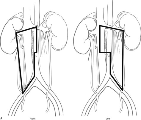 Laparoscopic And Robotic Assisted Retroperitoneal Lymph Node Dissection