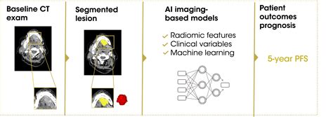 Development Of Ct Based Radiomic Model To Predict 5 Year Progression