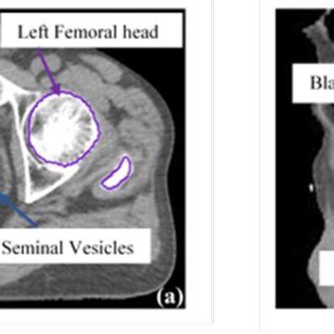 An Example Of The Structure Of The Clinical Target Volumes CTVs And