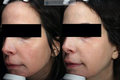 Rosacea Specialist Washington Dc Center For Laser Surgery