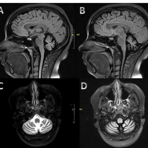 Mri Of The Brain Demonstrating Moderate To Severe Cerebellar Atrophy Download Scientific