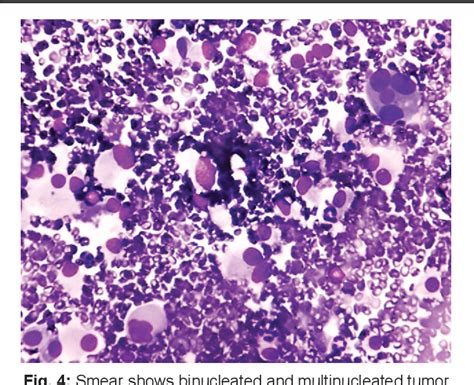 Figure 2 From Cytomorphological Features Of Medullary Thyroid Carcinoma