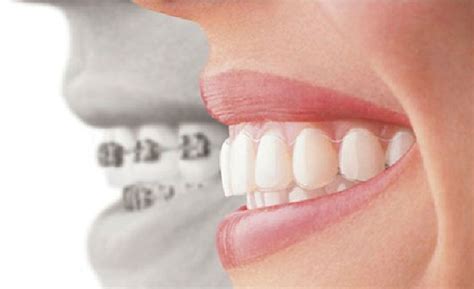 Orthodontic Treatment In Vadodara Monarch Dental Clinic