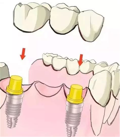 图解：种牙与镶牙的区别，缺牙的赶紧看爱牙宣教陕西嘉友科贸有限公司