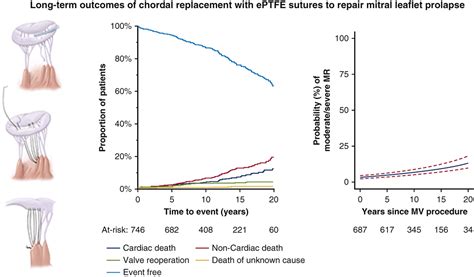 Long Term Outcomes Of Chordal Replacement With Expanded Polytetrafluoroethylene Sutures To