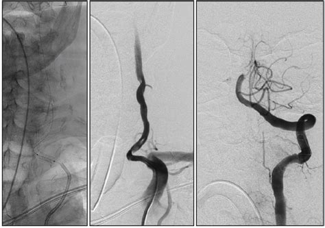 Endovascular Today Basilar Thrombus And Occlusion Of The Left