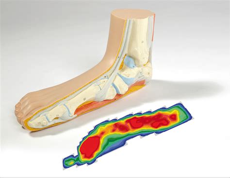 Flat Valgus Foot Surgical Procedure After Care And Costs Joint