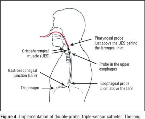 Figure From The Clinical Value Of Pharyngeal Ph Monitoring Using A