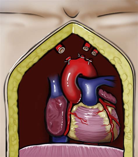 Normothermic Regional Perfusion Ethical Issues In Thoracic Organ