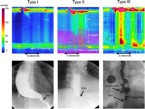 Presentation Diagnosis And Management Of Achalasia Clinical