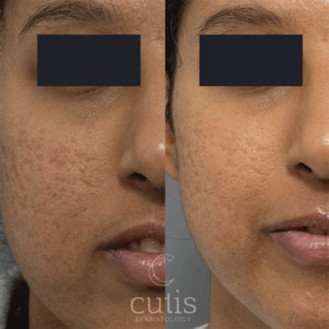 Acne Scars Cutis Dermatology