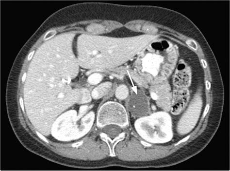 Cystic Adrenal Masses Spectrum Of Multimodality Imaging Features And Pathological Correlation