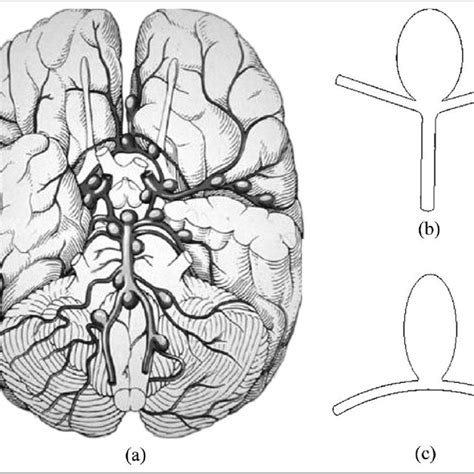 (a) Typical locations of intracranial aneurysms; aneurysms classified ...