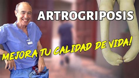 Artrogriposis C Mo Mejorar La Vida De Los Que Nacen Con La Enfermedad