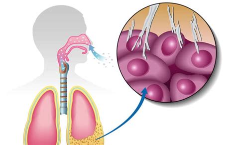 Malignant Pleural Mesothelioma - GMKA - Global Medical Knowledge Alliance