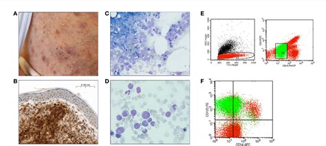 Figure From Real World Evidence On Tagraxofusp For Blastic