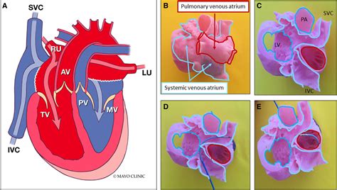 Atrial Arrhythmia Ablation In Patients With D Transposition Of The