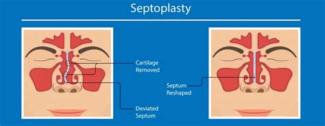 Septoplasty Indications Procedure And Recovery