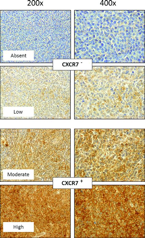 Representative CXCR7 Immunostaining Of DLBCL Tissue Sections The DLBCL