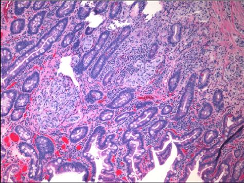 Microscopic Examination Of Excisional Biopsy Of Ampullary Tumor H E