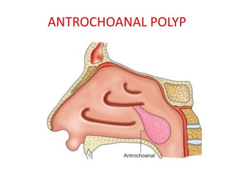 Nasal Polyps Ppt