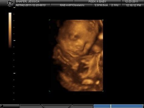 3D Ultrasound: Twins 3d Ultrasound