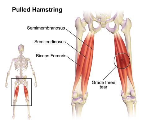 Hamstring Injury Motus Physical Therapy