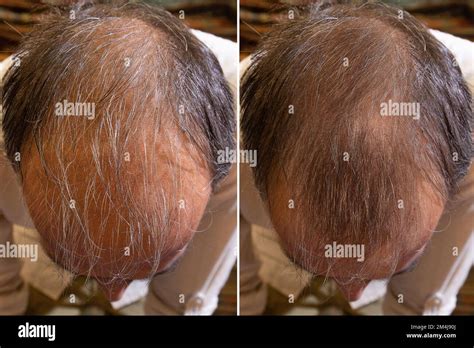 Top View Before And After Baldness Treatment Details Of The Hair Of A Man Suffering From