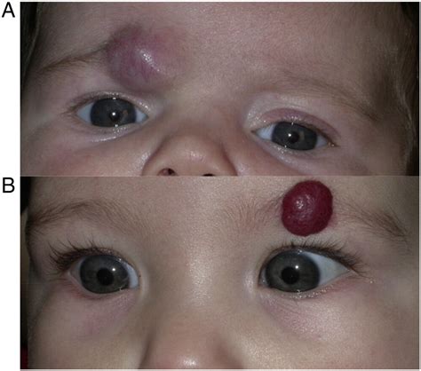 Hemangiomas And The Eye Clinics In Dermatology