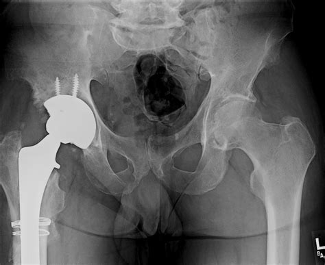 Hip Replacement St Louis Mo Open Hip Dislocation St Louis Mo