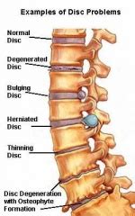 Lumbar Spondylosis - Physiopedia