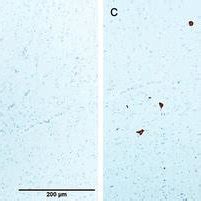 Psp And Comorbid Pathologies A Neurofibrillary Tangle Nft Of Globose