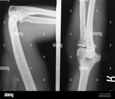 Radiografía De La Articulación Del Codo Fotografía De Stock Alamy