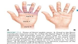 Flexor Tendon Injury Zones Page Zone 2: No Man's Land, 59% OFF