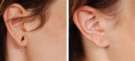 How To Shrink An Ear Piercing Hole Surgical Natural Solutions