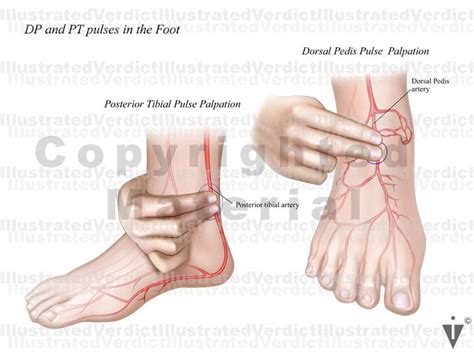 Stock Lower Limb Vasculature Illustrated Verdict