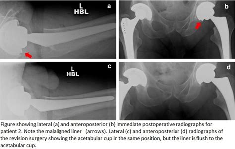 Pre And Post Revision Radiograph For Patient Two Download Scientific