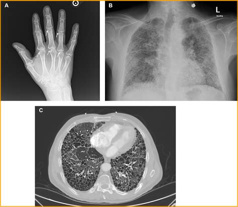 Rheumatoid Arthritis Associated Interstitial Lung Disease The American Journal Of The Medical