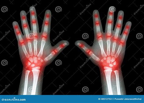 Rhumatisme Articulaire Radiographiez Les Mains Denfant Et Larthrite