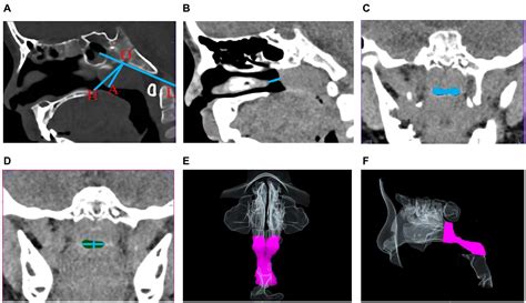 Frontiers Diagnostic Value Of Upper Airway Morphological Data Based