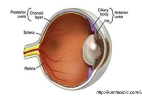 Anterior Uveitis Flashcards Quizlet