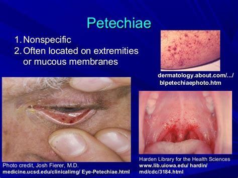 Infective Endocarditis 1 2