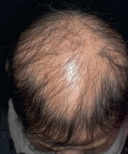 Caderea Parului Sau Alopecia Dermaonline Dermatologie Cluj