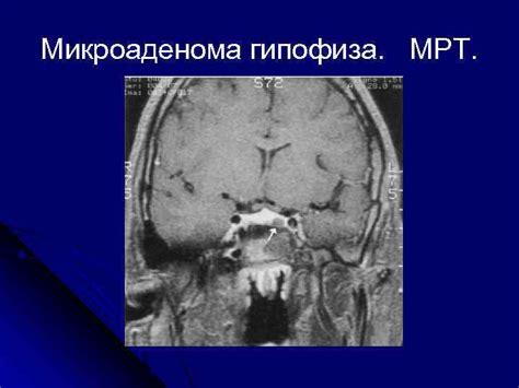 МРТ метод выбора для исследования патологии гипофиза