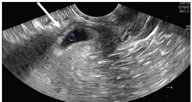 Cesarean Scar Ectopic Pregnancy Diagnosis With Ultrasound The