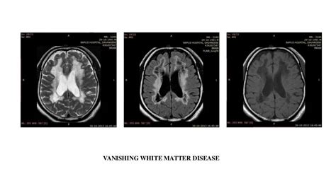 White Matter Disease Mri Mri Lesions Diffuse Axial Diseases Club Center