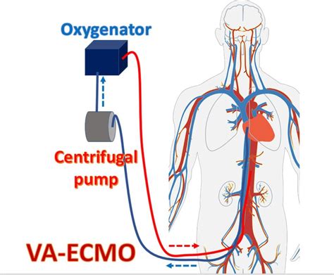 Extracorporeal CPR ECPR All About Cardiovascular System And Disorders