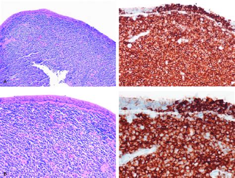 A And B Hematoxylin And Eosin Staining Showed Atypical Small Lymphoid